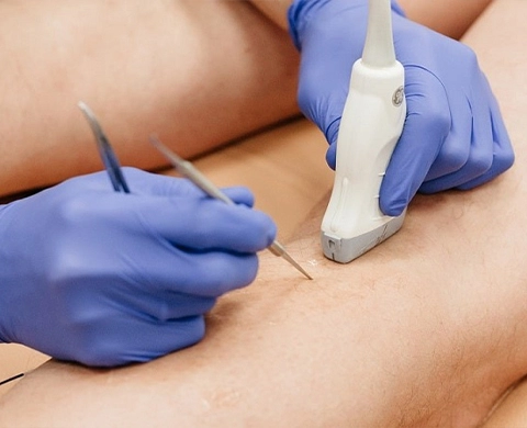 هزینه لیزر واریس پا در شیراز