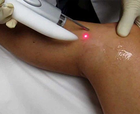 هزینه لیزر واریس پا در شیراز