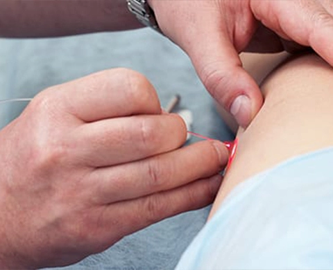 هزینه لیزر واریس پا در شیراز