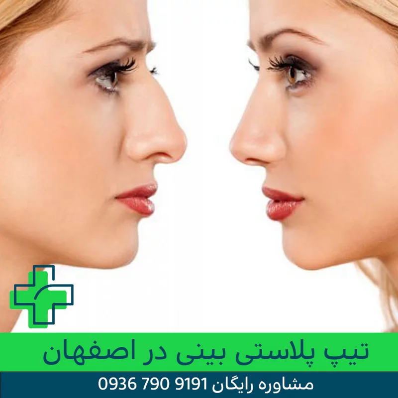تیپ پلاستی بینی در اصفهان تیپ پلاستی بینی در اصفهان