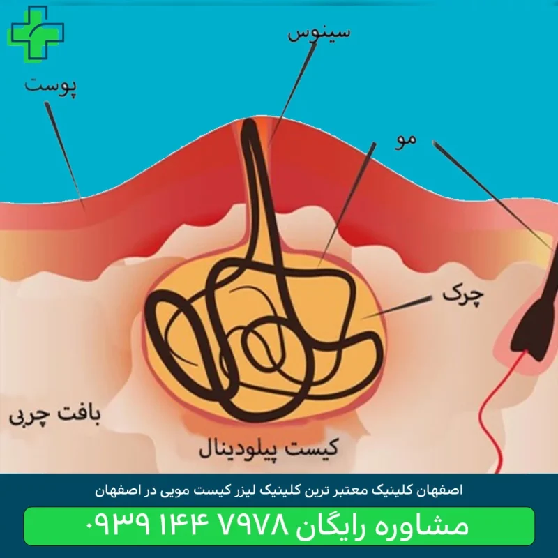 کلینیک لیزر کیست مویی در اصفهان