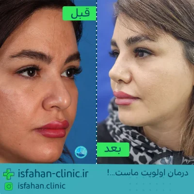 تزریق فیلر بینی در اصفهان