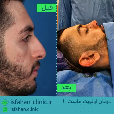 تزریق فیلر بینی در اصفهان