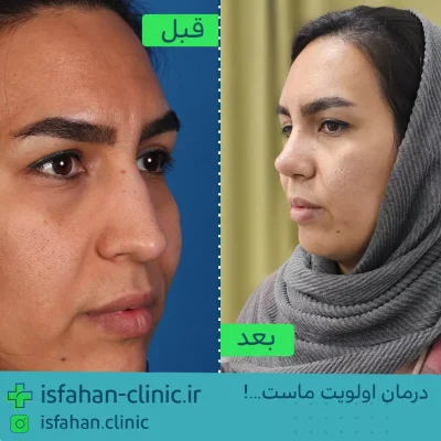 تزریق فیلر بینی در اصفهان