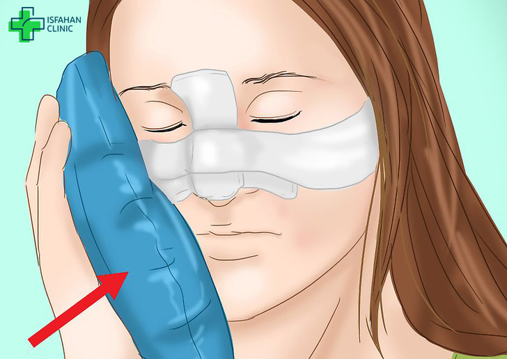 مراقبتهای بعد از عمل بینی مراقبتهای بعد از عمل بینی