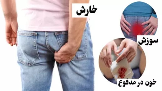 هموروئید چیست؟ علائم بیماری هموروئید