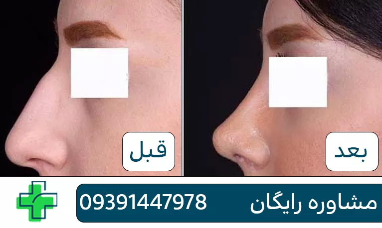 بهترین دکتر عمل بینی در اصفهان برای عمل بینی بهترین دکتر عمل بینی در اصفهان برای عمل بینی