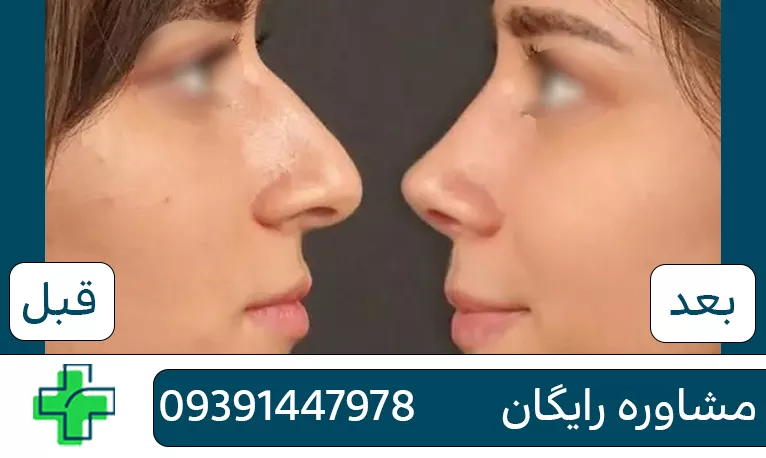 بهترین دکتر عمل بینی در اصفهان برای عمل بینی بهترین دکتر عمل بینی در اصفهان برای عمل بینی