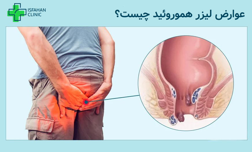 عوارض بعد از عمل هموروئید با لیزر