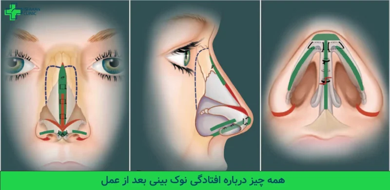 افتادگی نوک بینی بعد از عمل