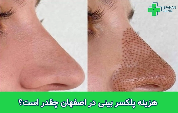 هزینه پلکسر بینی در اصفهان هزینه پلکسر بینی در اصفهان