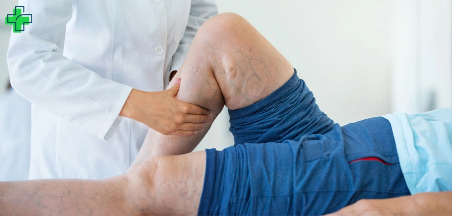 لیزر واریس پا