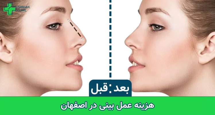 هزینه عمل بینی در اصفهان