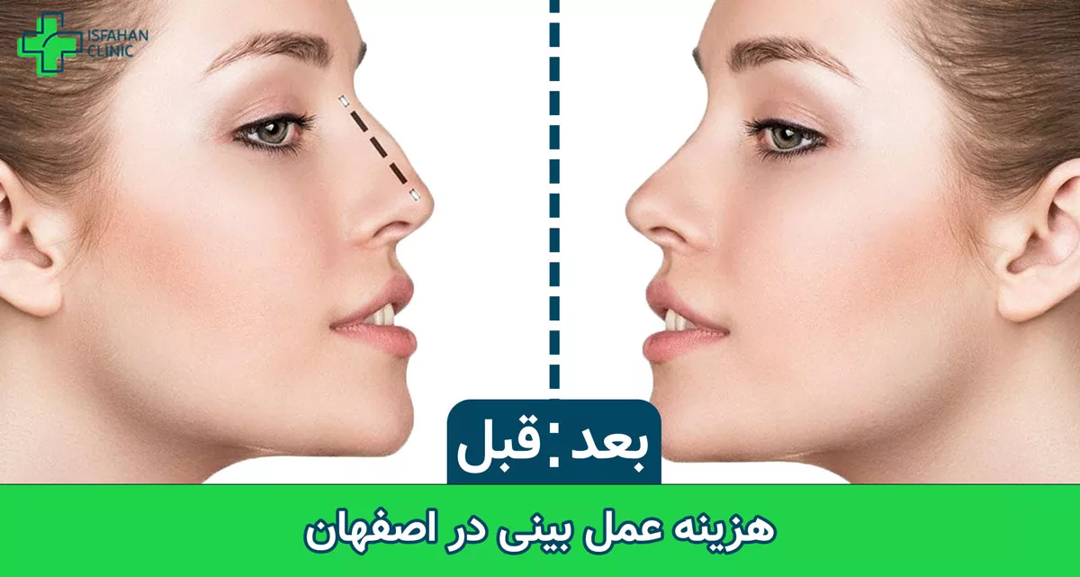 هزینه عمل بینی در اصفهان هزینه عمل بینی در اصفهان