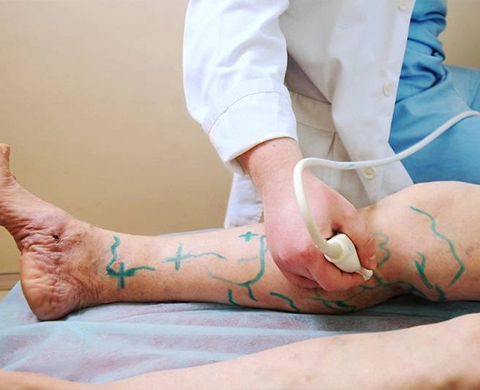 هزینه لیزر واریس پا در اصفهان