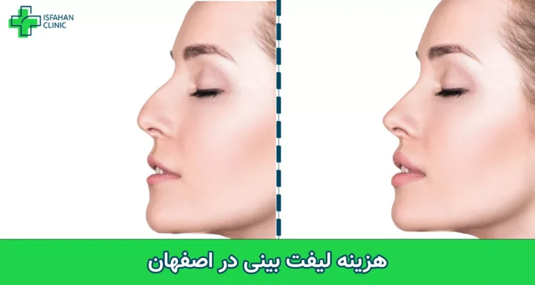هزینه لیفت بینی در اصفهان چقدر است؟