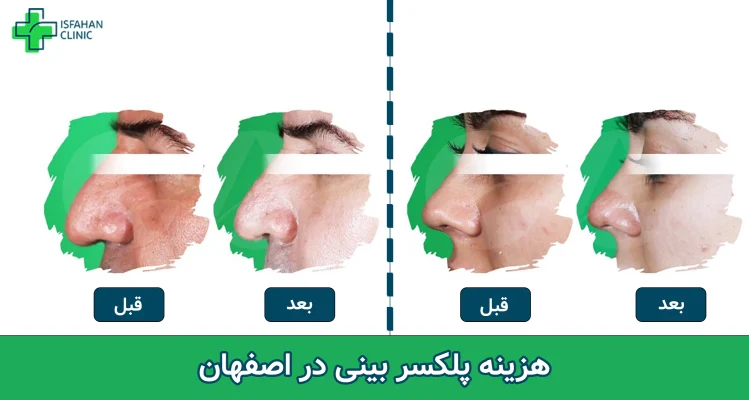 هزینه پلکسر بینی در اصفهان
