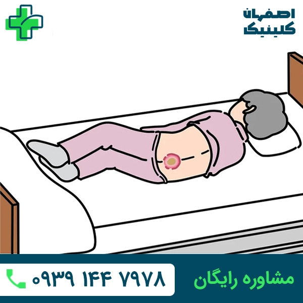 درمان زخم بستر در اصفهان درمان زخم بستر در اصفهان