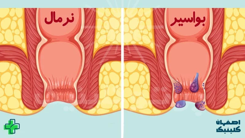 علائم هموروئید: شناخت و درمان علائم این بیماری شایع علائم هموروئید: شناخت و درمان علائم این بیماری شایع