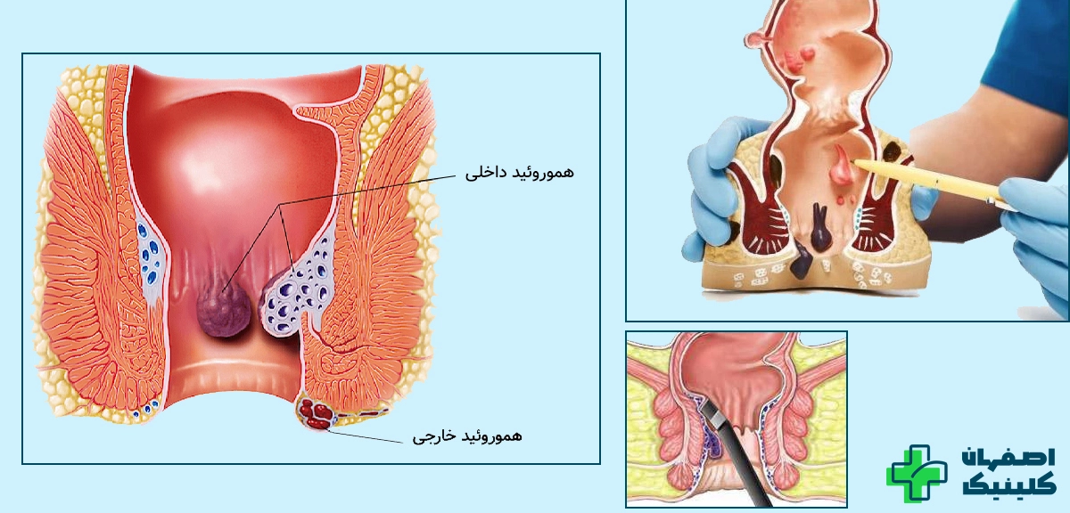 لیزر بواسیر چگونه انجام می‌شود؟