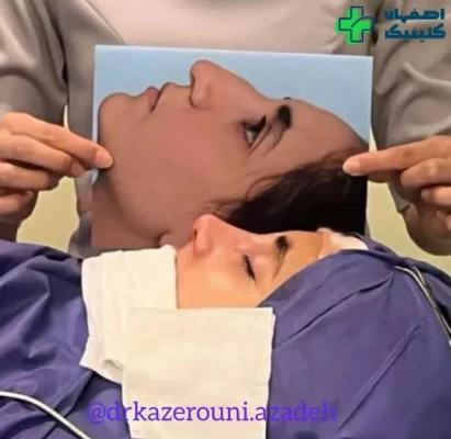 بهترین دکتر عمل بینی در اصفهان برای عمل بینی نمونه عمل بینی دکتر آزاده کازرونی شماره 1