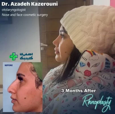 بهترین دکتر عمل بینی در اصفهان برای عمل بینی نمونه عمل بینی دکتر آزاده کازرونی شماره 2