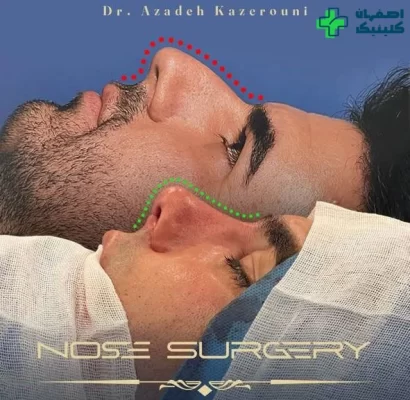 بهترین دکتر عمل بینی در اصفهان برای عمل بینی نمونه عمل بینی دکتر آزاده کازرونی شماره 3