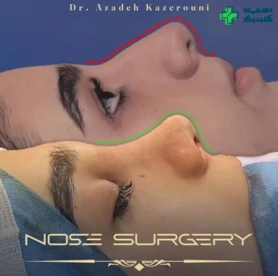 بهترین دکتر عمل بینی در اصفهان برای عمل بینی نمونه عمل بینی دکتر آزاده کازرونی شماره 4