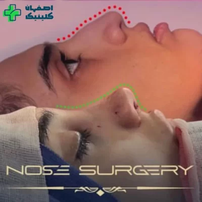 بهترین دکتر عمل بینی در اصفهان برای عمل بینی نمونه عمل بینی دکتر آزاده کازرونی شماره 6