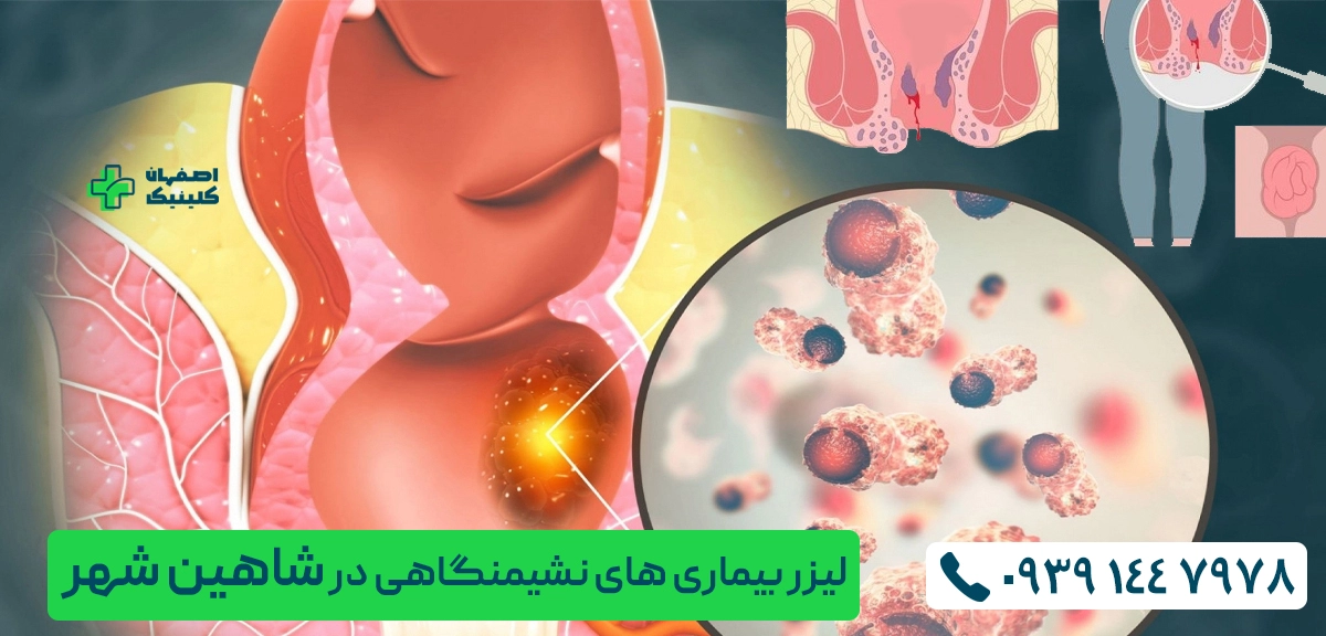 برای لیزر بیماری های نشیمنگاهی در شاهین شهر به کجا مراجعه کنیم؟ لیزر هموروئید در شاهین شهر