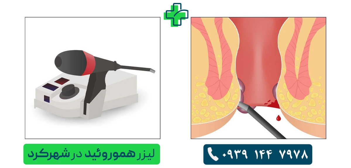 برای لیزر بیماری های نشیمنگاهی در شهرکرد به کجا مراجعه کنیم؟ لیزر هموروئید در شهرکرد