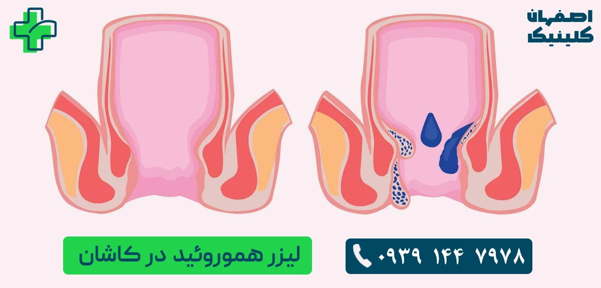 برای لیزر بیماری های نشیمنگاهی در کاشان به کجا مراجعه کنیم؟ برای لیزر بیماری های نشیمنگاهی در کاشان به کجا مراجعه کنیم؟