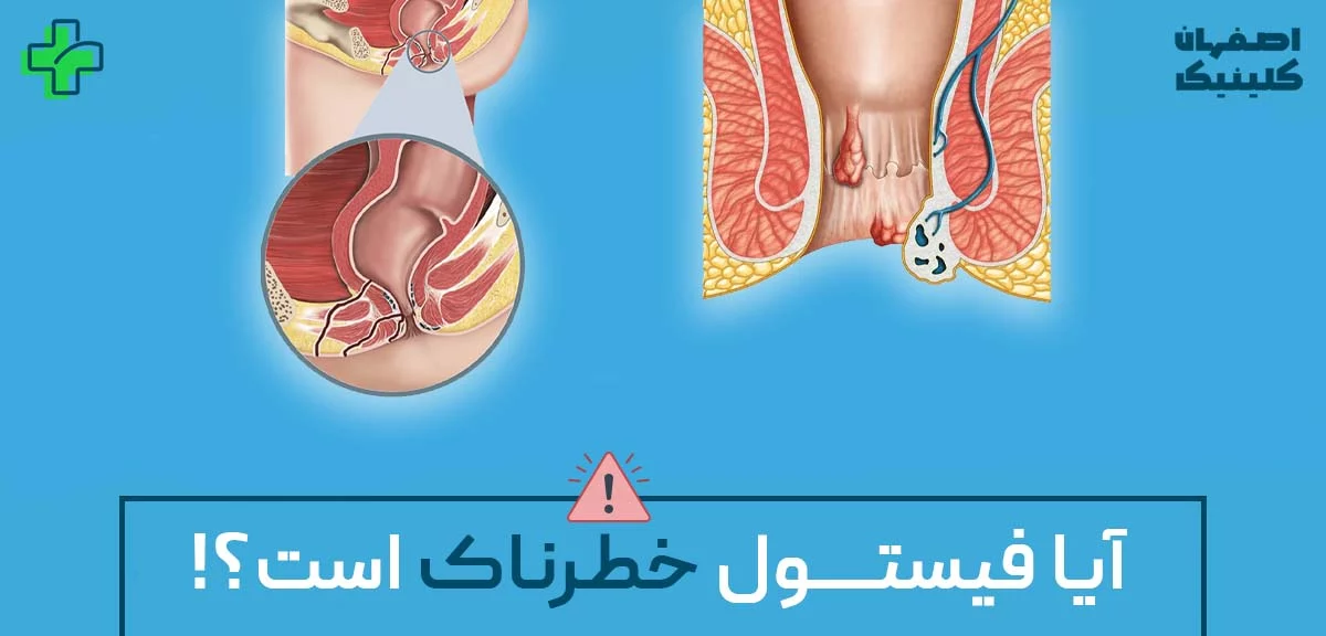 آیا فیستول خطرناک است؟ بررسی علمی عوارض، علل و راهکارهای پیشگیری و درمان آیا فیستول خطرناک است