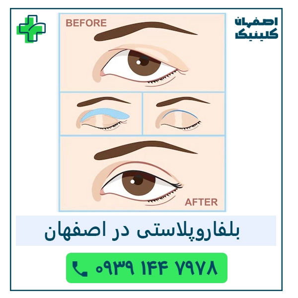 بلفاروپلاستی در اصفهان