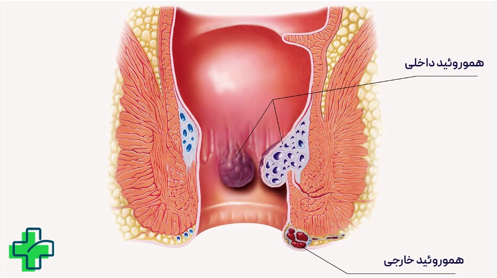بیرون‌زدگی مقعد چیست؟
