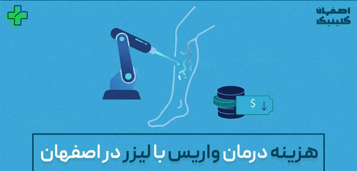 هزینه درمان واریس با لیزر در اصفهان