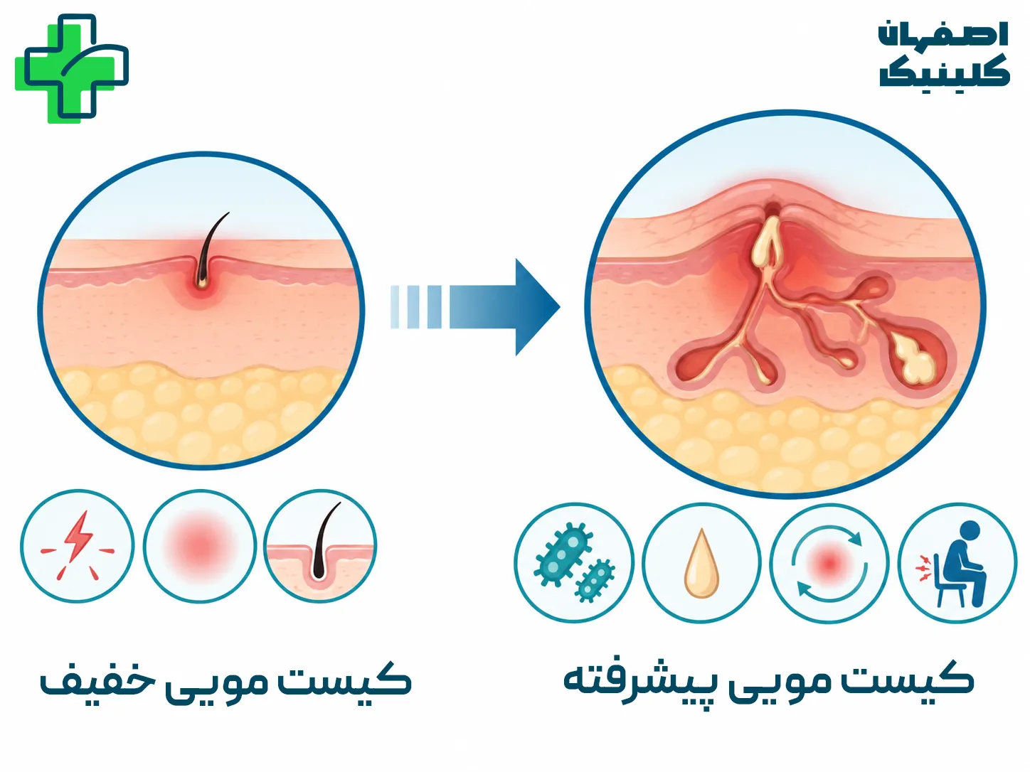 عوارض عمل نکردن کیست مویی چیست؟ خطرات تأخیر در درمان تفاوت کیست مویی خفیف و کیست مویی پیشرفته