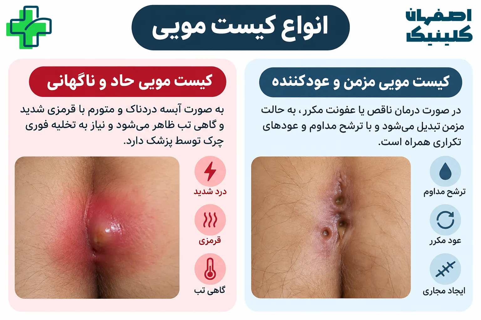 کیست مویی چیست؟ انواع و محل ایجاد انواع کیست مویی