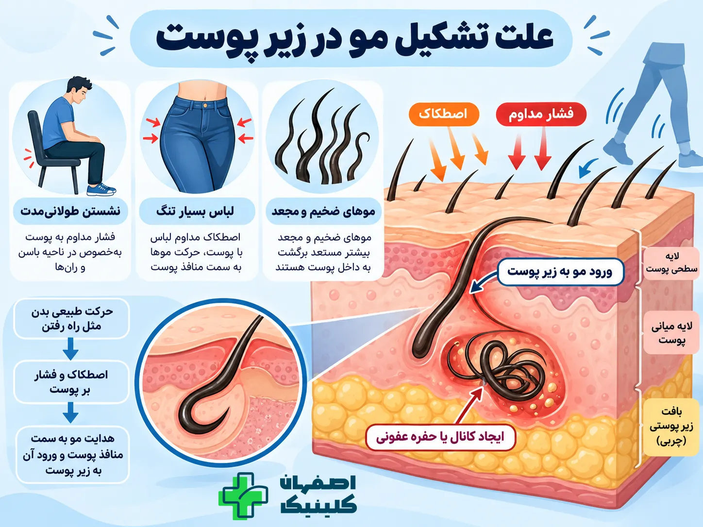 کیست مویی چیست؟ انواع و محل ایجاد علل تشکیل موهای زیرپوستی