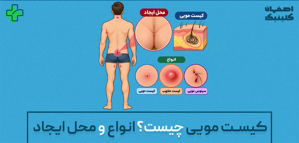 کیست مویی چیست؟ انواع و محل ایجاد کیست مویی چیست؟ انواع و محل ایجاد